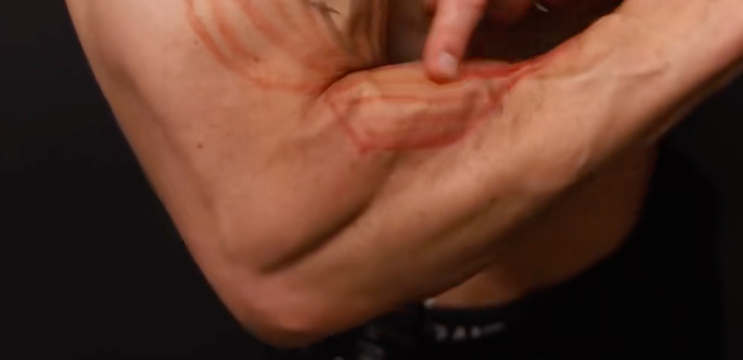 Brachioradialis