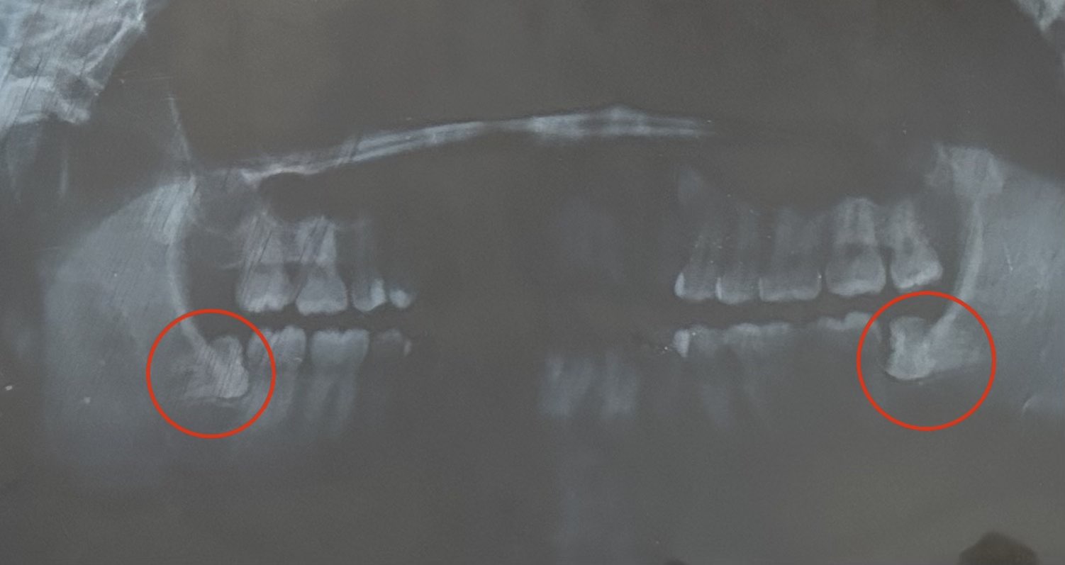 Impacted wisdom teeth