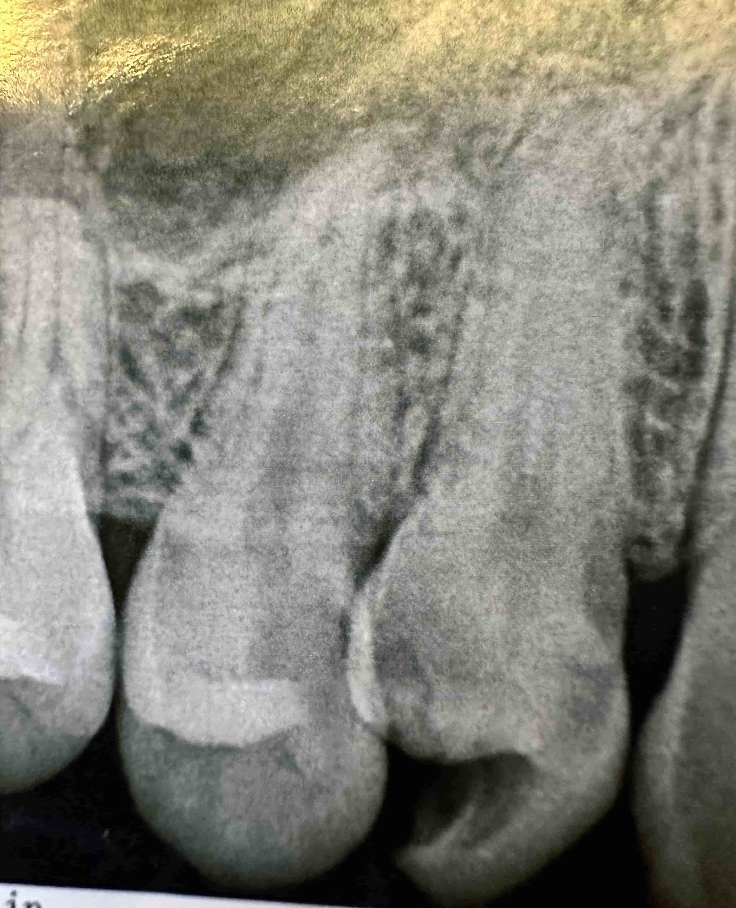 Tooth decay